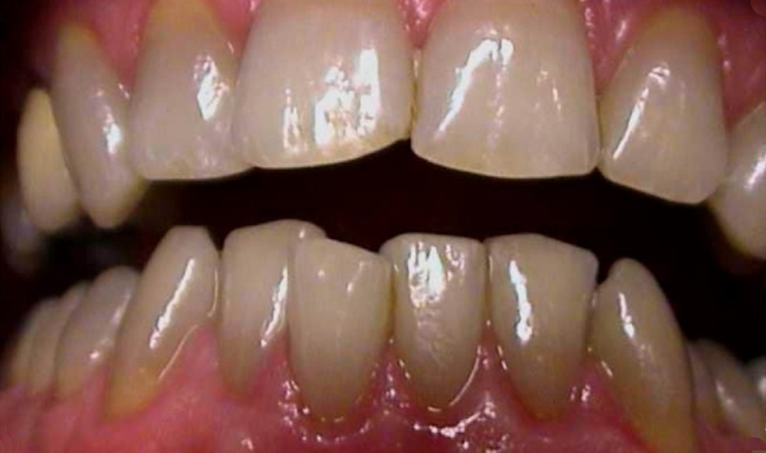 nanowhite_tandenbleken Close-up van tanden vóór cosmetische tandheelkundige behandeling. Resultaten.