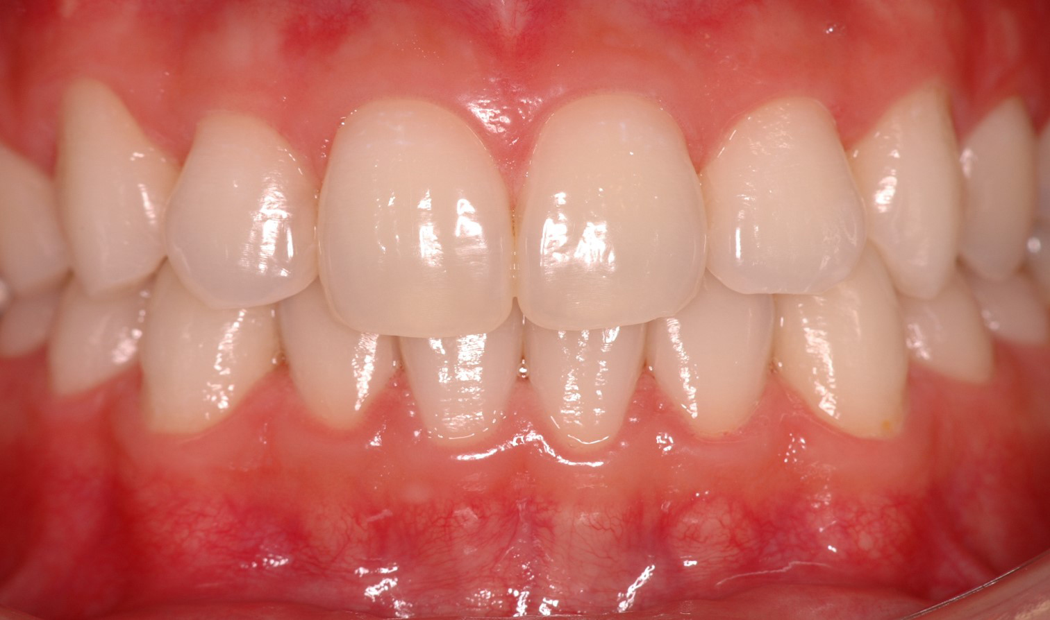nanowhite_tandenbleken Close-up van gezonde, stralend witte tanden na een tandheelkundige behandeling. Prachtige glimlach als resultaat.