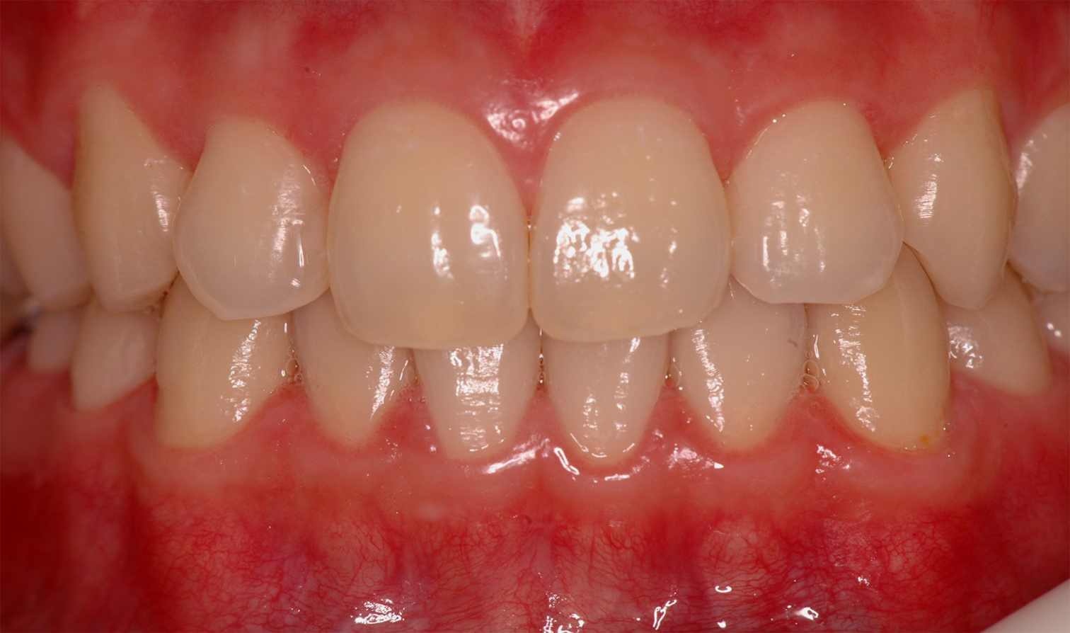 nanowhite_tandenbleken Close-up van gezonde, heldere tanden na een tandheelkundige behandeling. Uitstekende resultaten.