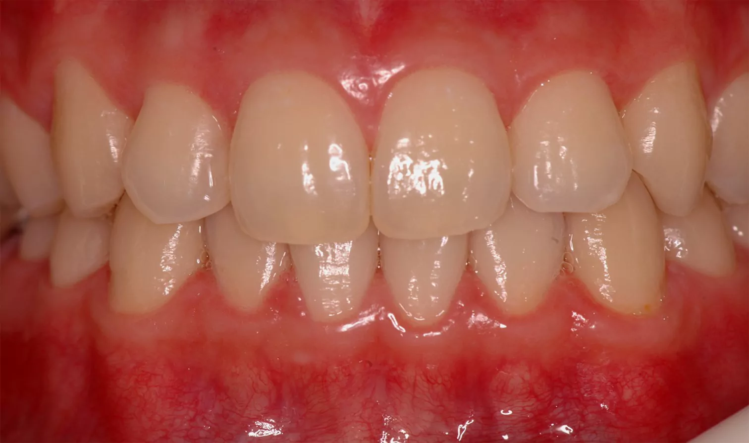 nanowhite_tandenbleken Close-up van gezonde, heldere tanden na een tandheelkundige behandeling. Uitstekende resultaten.