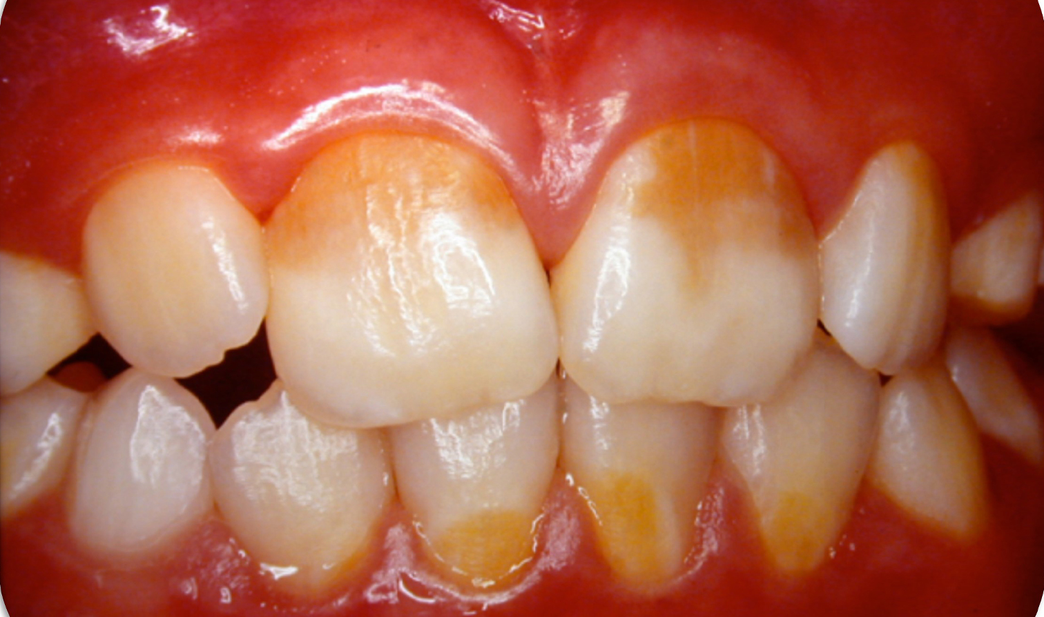 nanowhite_tandenbleken Close-up van tanden met vlekken vóór de behandeling. Resultaten.