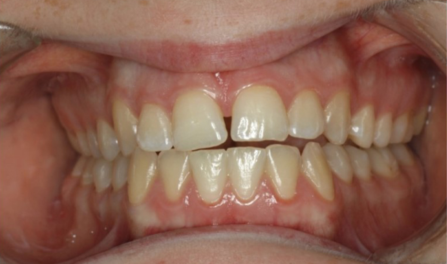 nanowhite_tandenbleken Close-up van tanden voor orthodontische behandeling. Resultaten.