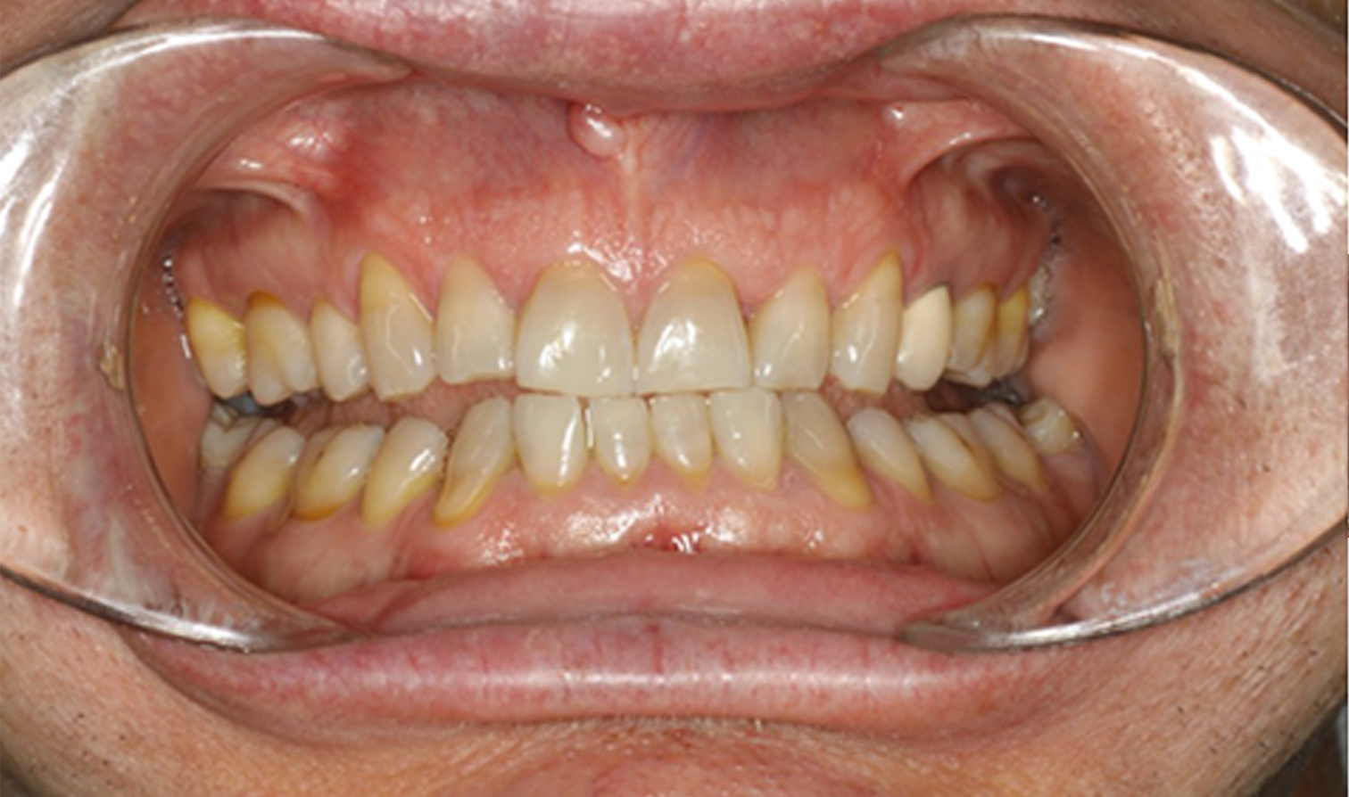 nanowhite_tandenbleken Close-up van tanden vóór cosmetische tandheelkundige behandeling. Resultaten weergegeven.