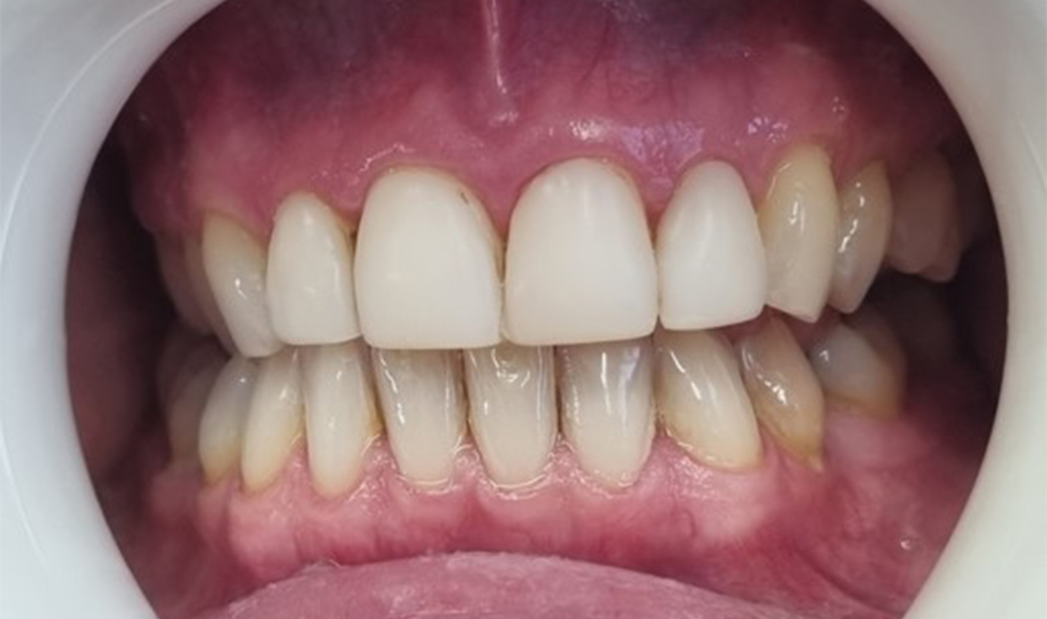 nanowhite_tandenbleken Close-up van een glimlach na een tandheelkundige behandeling, met gezonde, stralende tanden.