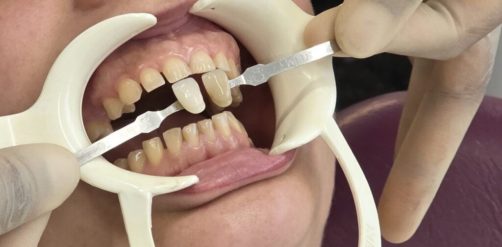 nanowhite_tandenbleken Close-up van een tandbleekprocedure, waarbij de tanden worden gekleurd voor effectief tanden bleken.