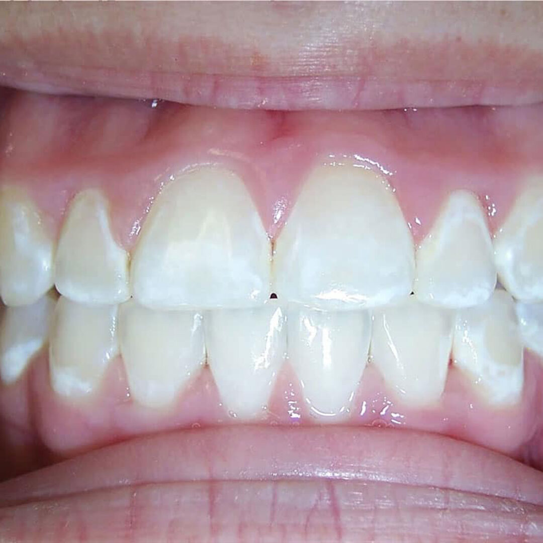 nanowhite_tandenbleken_wittere_tanden Close-up van tanden die mogelijke schade door het bleken van de tanden laat zien.